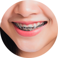 จัดฟันลวด