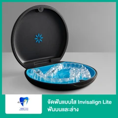 จัดฟันแบบใส Invisalign Lite ฟันบนและล่าง