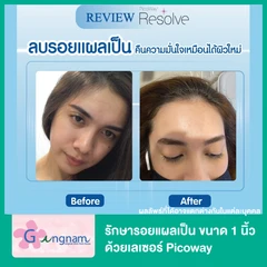 รักษารอยแผลเป็น ขนาด 1 นิ้ว ด้วยเลเซอร์ Picoway
