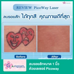 ลบรอยสักขนาด 1 นิ้ว ด้วยเลเซอร์ Picoway