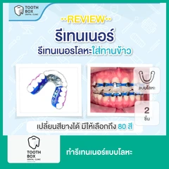 ทำรีเทนเนอร์แบบโลหะ 2 ชิ้น ฟันบนและล่าง