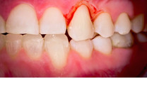 โรคเหงือกอักเสบ (Gingivitis) คืออะไร ?