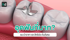 รวมราคาอุดฟัน ทั้งโรงพยาบาลและคลินิก