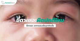 ขี้ตาเยอะ ในโรคเยื่อบุตาอักเสบจากการติดเชื้อ