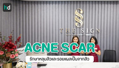 รีวิว PicoWay Acne Scar รักษาหลุมสิวและรอยแผลเป็นจากสิว ที่เดอะไซน์ คลินิก (The Sign Clinic)