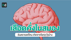 เลือดคั่งในสมองเป็นอย่างไร อาการที่สังเกตได้ และวิธีรักษา
