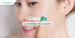รักษาสิว รวมสารพัดวิธีรักษาสิวให้หายขาด! ด้วยวิธีแบบธรรมชาติ