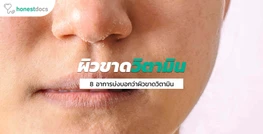 8 ปัญหาผิวที่เกิดจากการขาดวิตามิน