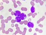 มะเร็งเม็ดเลือดขาวเฉียบพลันชนิดไมอีลอยด์ (Acute myeloid leukaemia) (โรคมะเร็งเม็ดเลือดขาวเฉียบพลันเอเอ็มแอล)