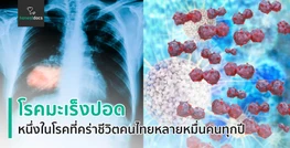 โรคมะเร็งปอด (Lung cancer)
