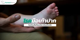 โรคมือเท้าปาก