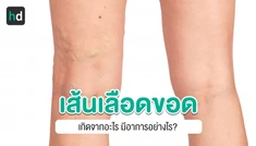 เส้นเลือดขอด (Varicose Veins)