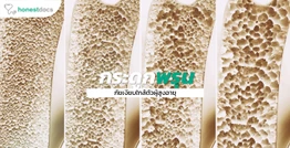 กระดูกพรุน ภัยเงียบใกล้ตัว