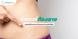 เลเซอร์ลบรอยแตกที่ท้อง