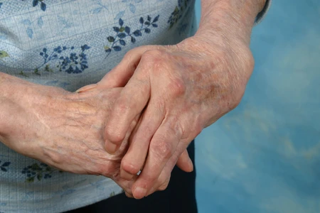 14. ข้ออักเสบรูมาตอยด์  (Rheumatoid arthritis)