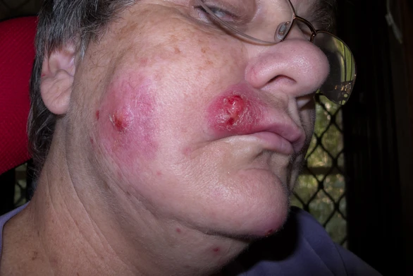 Staphylococcus Aureus Infection - สาเหตุ อาการ การรักษา ป้องกัน