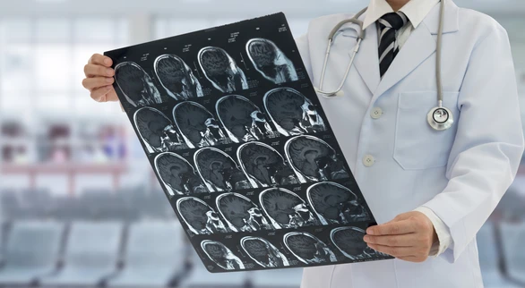 TIA: Transient Ischemic Attack - สาเหตุ อาการ การรักษา ป้องกัน