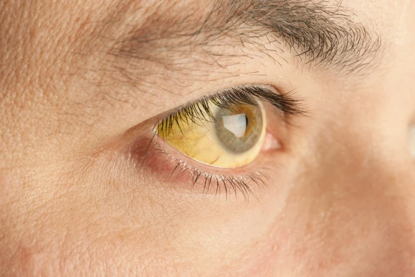 Jaundice - สาเหตุ อาการ การรักษา ป้องกัน