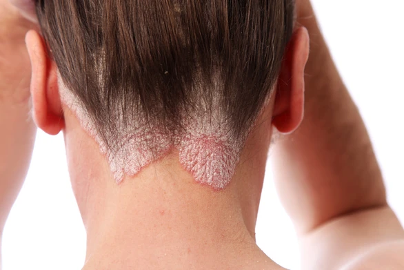 Scalp Psoriasis - สาเหตุ อาการ การรักษา ป้องกัน