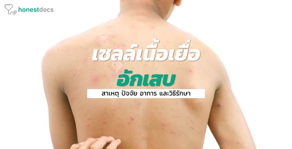 Cellulitis - สาเหตุ อาการ การรักษา ป้องกัน