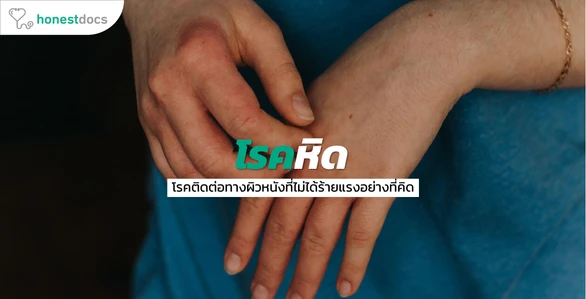 หิด - สาเหตุ อาการ การรักษา ป้องกัน