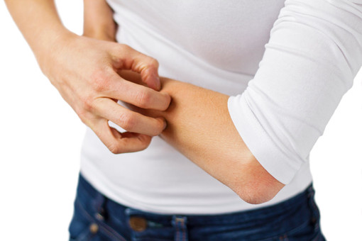 โรคผิวหนังอักเสบผื่นแพ้ (Eczema)