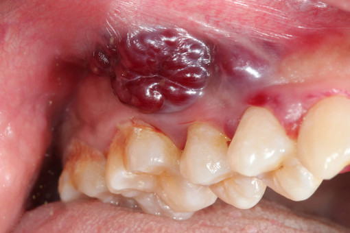 สุขอนามัยในช่องปากที่ไม่ดีสามารถนำไปสู่การเกิดมะเร็งช่องปากได้