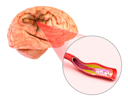 ภาวะสมองขาดเลือดชั่วคราว (transient ischaemic attack (TIA))