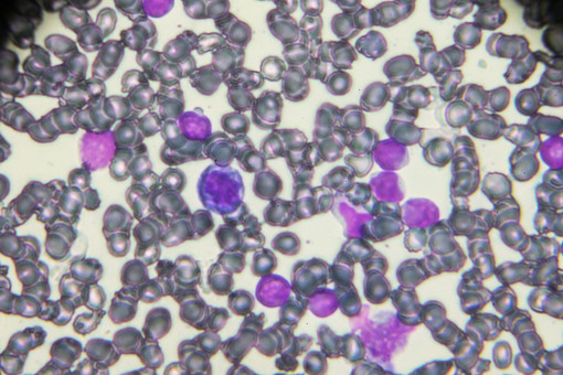 มะเร็งเม็ดเลือดขาวเฉียบพลันชนิดเอแอลแอล (Acute lymphoblastic leukaemia)