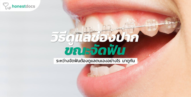 การดูแลช่องปากระหว่างจัดฟันให้ถูกวิธี