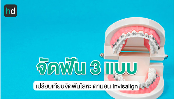 เปรียบเทียบความแตกต่างของการจัดฟัน 3 แบบ แบบลวดเหล็ก แบบดามอน แบบ Invisalign
