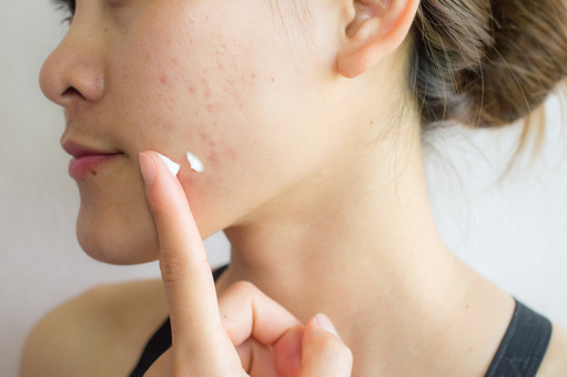 สิว (Acne)