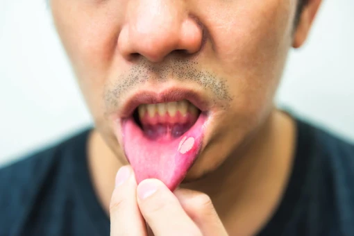 8 สาเหตุหลักที่พบได้บ่อยของการเกิดโรคปากร้อนใน (โรคปากเปื่อย)