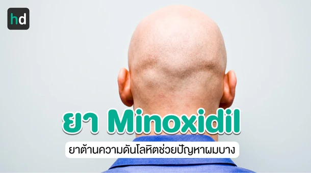 Minoxidil (ไมนอกซิดิล) - ยาต้านความดันโลหิตสูงที่สามารถรักษาโรคผมร่วงในเพศชาย