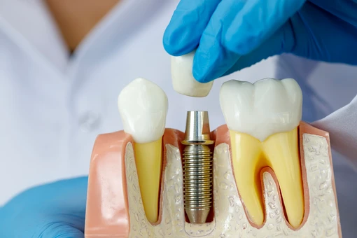 ความรู้เกี่ยวกับรากฟันเทียม ข้อดี - เสีย และเหตุผลที่ควรจะใส่
