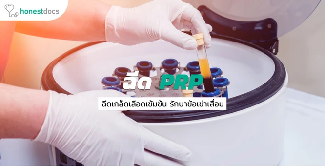 รู้จักการฉีดเกล็ดเลือดเข้มข้น PRP ทางเลือกการรักษาโรคข้อเข่าเสื่อม
