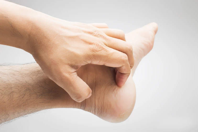 โรคน้ำกัดเท้า โรคผิวหนัง ที่เกิดจากการที่เท้าแช่อยู่ในน้ำ เป็นระยะเวลานาน 