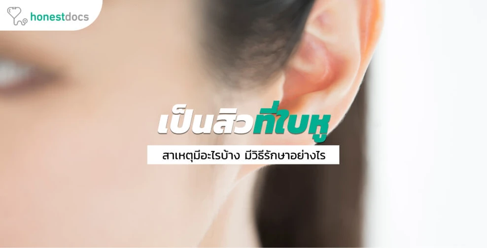 5 สาเหตุหลัก ปัญหาการเกิดสิวที่ใบหู มีอะไรบ้าง