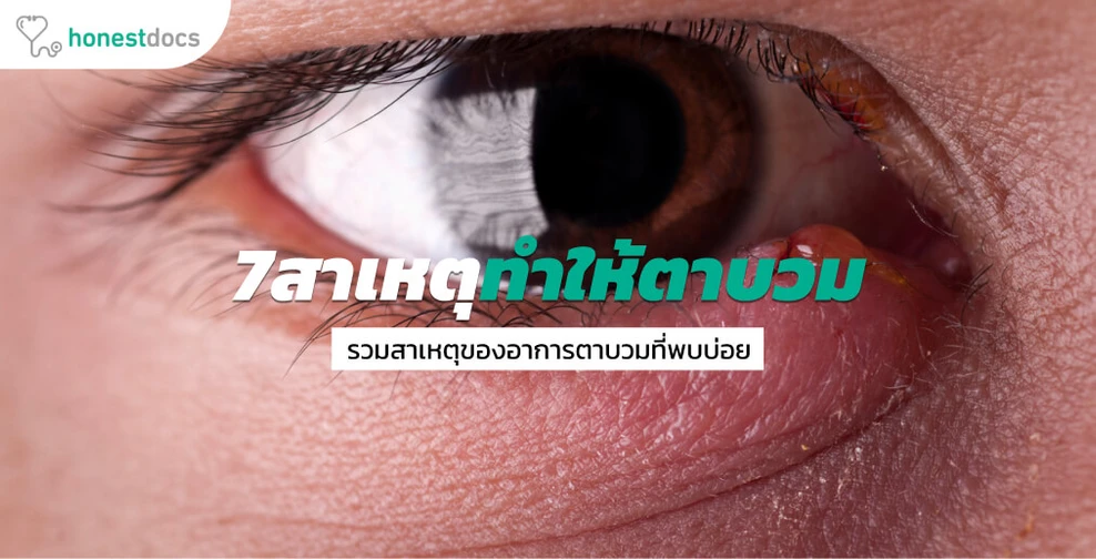7 สาเหตุของอาการตาบวม 