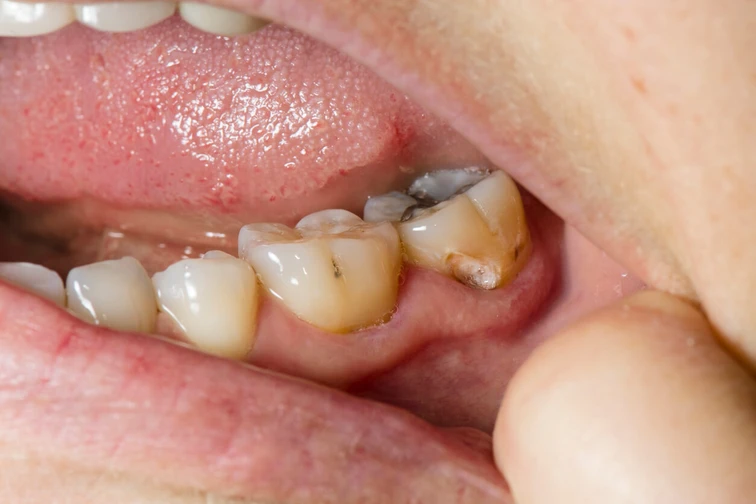 โรคฟันผุอาจอันตรายถึงชีวิต 3โรคที่อาจเกิดจากฟันผุ 