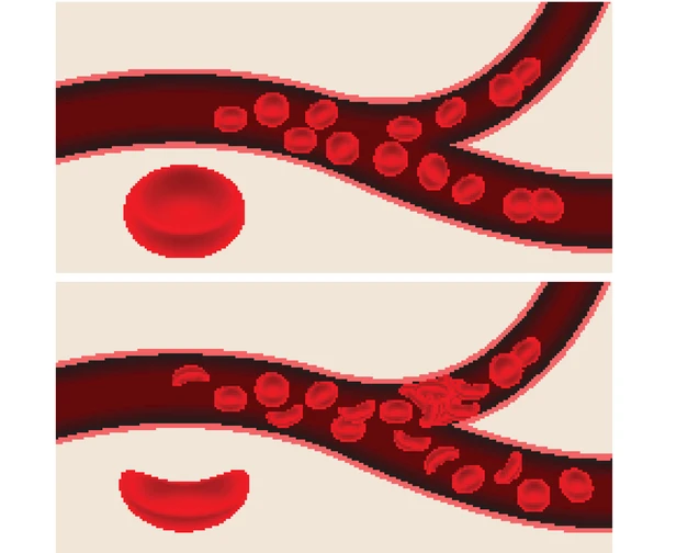 โรคเม็ดเลือดแดงรูปเคียว (Sickle cell disease)