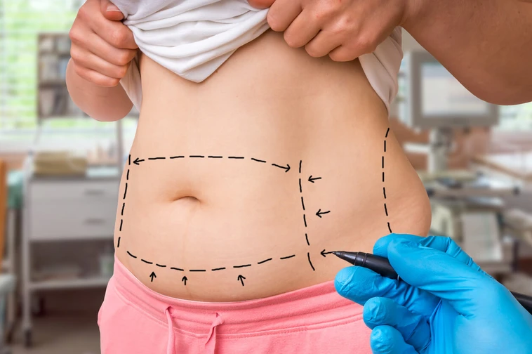 Vaser Liposuction คืออะไร วิธีการทำงาน ข้อดี ข้อเสีย ข้อควรระวัง เหมาะกับใคร วิธีการดูแลตัวเองก่อนและหลัง