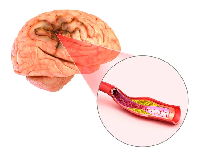 ภาวะสมองขาดเลือดชั่วคราว (transient ischaemic attack (TIA))