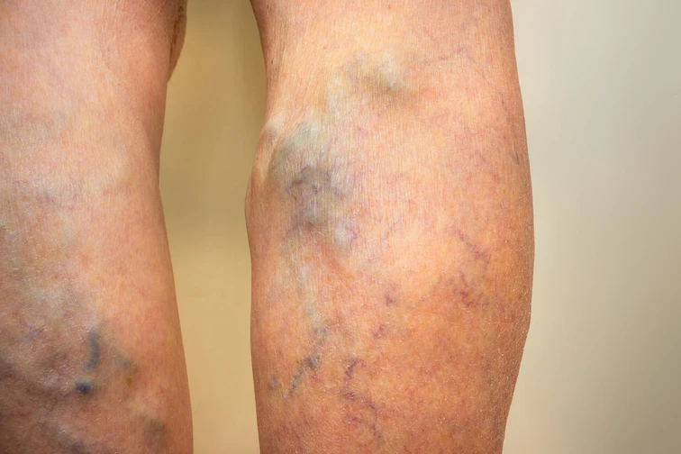 การมีลิ่มเลือดอุดตันที่ขา (Deep vein thrombosis)