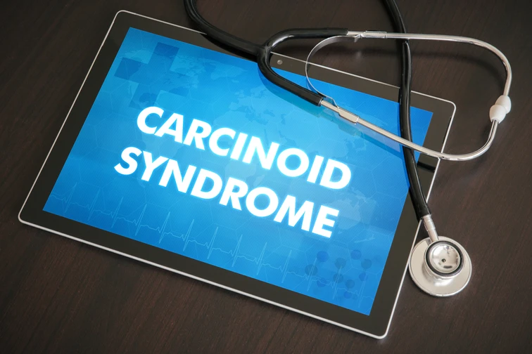 กลุ่มอาการคาร์ซินอยด์ และ เนื้องอกคาร์ซินอยด์ (Carcinoid syndrome and carcinoid tumours)