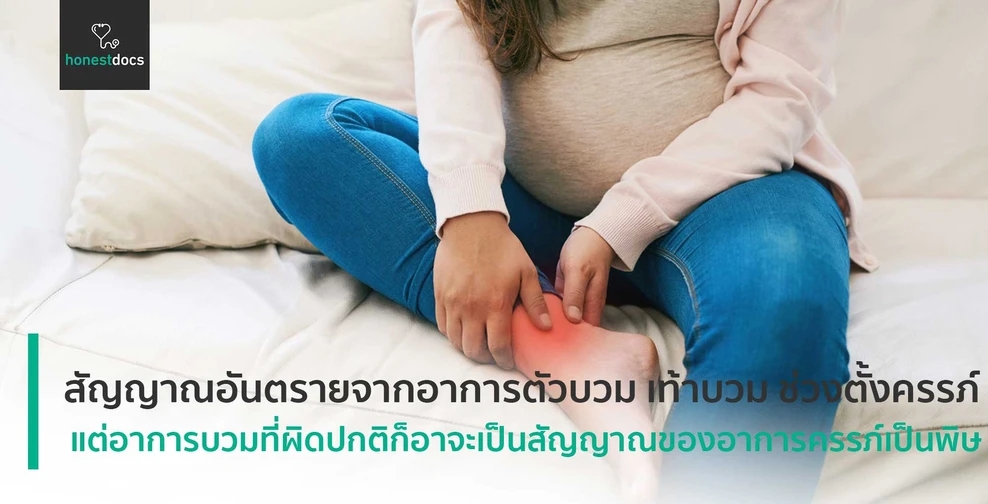 สัญญาณอันตรายจากอาการตัวบวม เท้าบวม ช่วงตั้งครรภ์