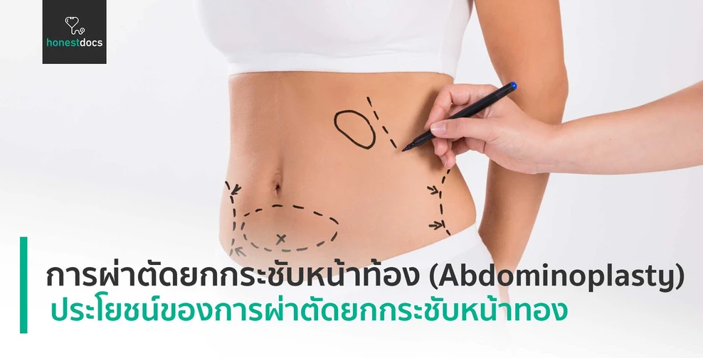 การผ่าตัดยกกระชับหน้าท้อง (Abdominoplasty)