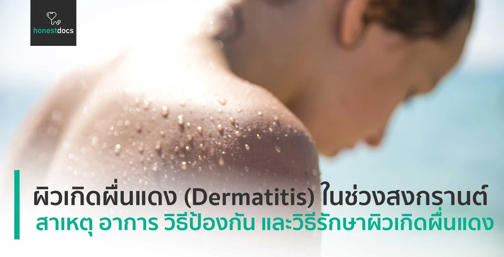 ผื่นคัน ผิวเกิดผื่นแดง (Dermatitis) ในช่วงสงกรานต์