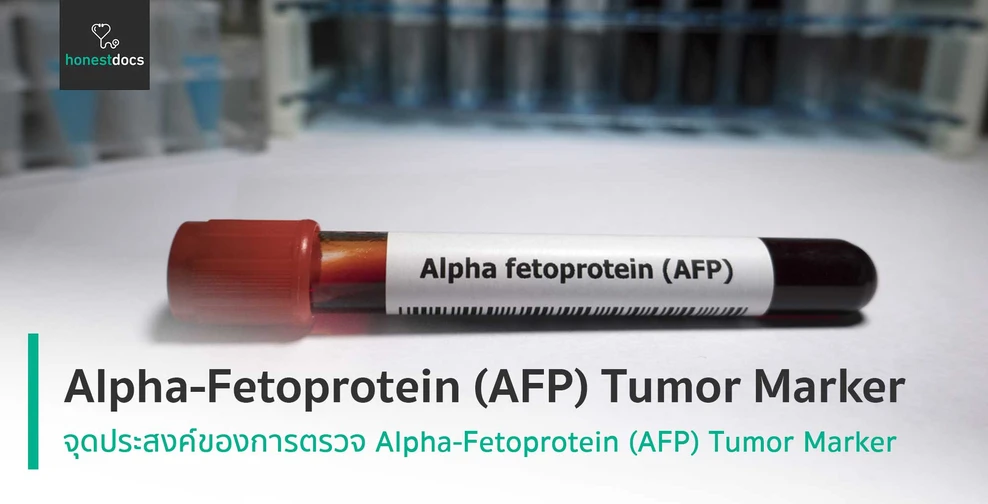 Alpha-Fetoprotein (AFP) Tumor Marker