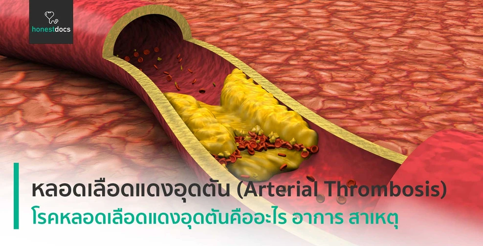 หลอดเลือดแดงอุดตัน (Arterial Thrombosis)